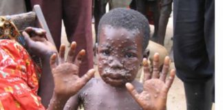 Kwara Confirms First Case Of Monkeypox