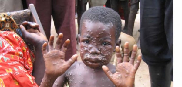 Monkeypox1-1-600x289