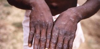 Nigeria Records 49 Monkeypox Cases – NCDC