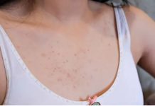 5 Ways to get rid of chest acne